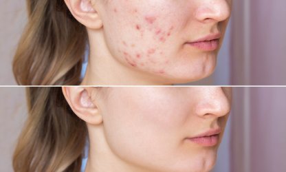 Acne Treatment - Medgel